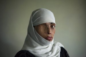 EMILIO MORENATTI. Busha Shari, atacada con ácido por su marido. Islamabad. Pakistan 2008